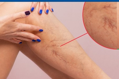 Varicele in panza de paianjen