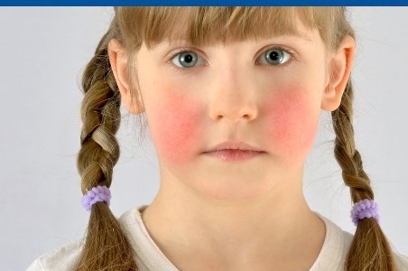 Boala obrajilor palmuiti (eritemul infectios)