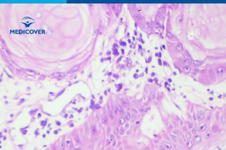 Carcinom: tipuri, diagnostic si tratament