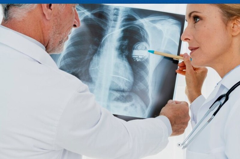 Fibroza pulmonara: tipuri, cauze, simptome si tratament