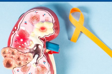 Crioablatia carcinomului renal: o&nbsp;solutie inovatoare in tratamentul cancerului renal