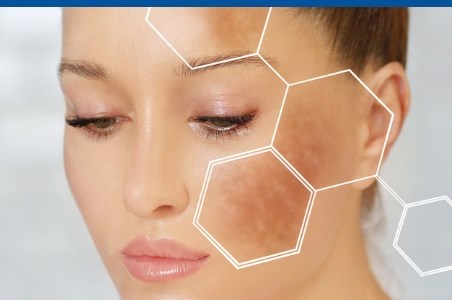 Melasma si excesul de melanina in timpul verii