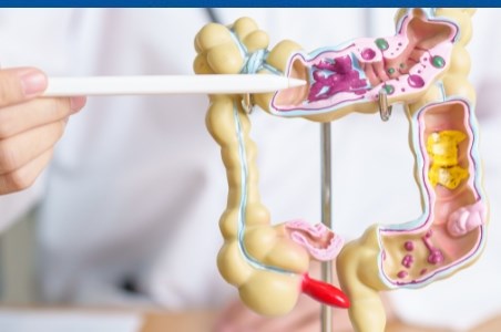 Diverticuloza colonica: simptome, diagnostic si tratament