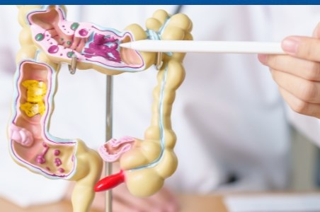 Cancerul de colon: cauze, simptome si tratament