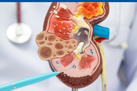Cancer renal: simptome, cauze, tratament si prognostic